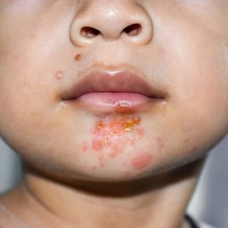 Impetigo