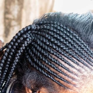 Traction Alopecia