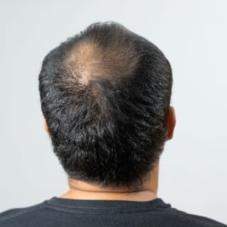 Male Pattern Hair Loss (Androgenetic Alopecia) – The DermBar